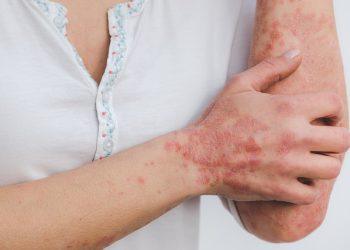 Using Light Therapy to Treat Psoriasis in 2022