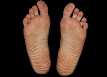 How You Can Stop Foot and Toenail Fungus In Its Tracks