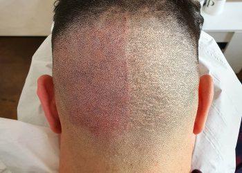 Top 9 Benefits of Scalp Micropigmentation