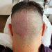 Top 9 Benefits of Scalp Micropigmentation