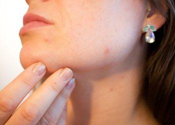 The Complete Guide to Treating Acne-Prone Skin