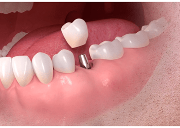 Benefits of Travelling to Turkey for Dental Implants