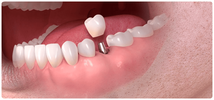 Benefits of Travelling to Turkey for Dental Implants