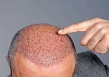Why Turkey is the Destination of Choice for Hair Transplant Surgery