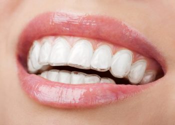 Why Invisalign is the Most Popular Orthodontic Treatment