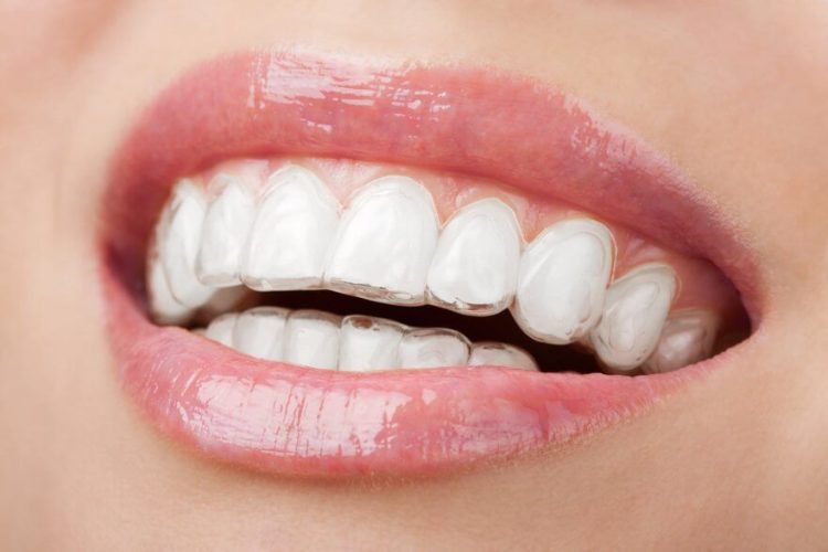 Why Invisalign is the Most Popular Orthodontic Treatment
