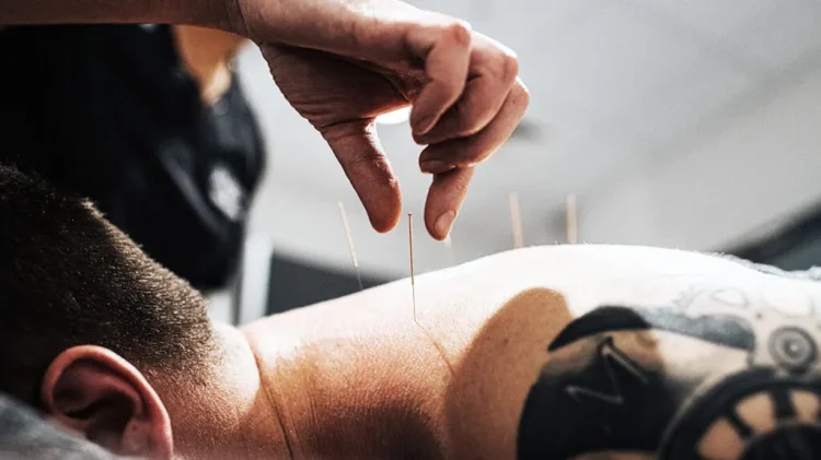 Unleashing Holistic Healing: The Benefits of Choosing Acupuncture in Chelsea