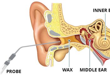 The Essential Guide to Ear Wax Removal