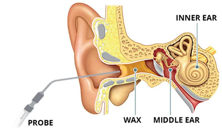 The Essential Guide to Ear Wax Removal