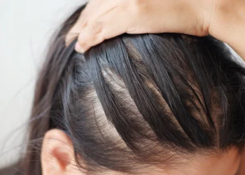 Reclaiming Your Crown: A Comprehensive Guide to Female Hair Loss Treatment