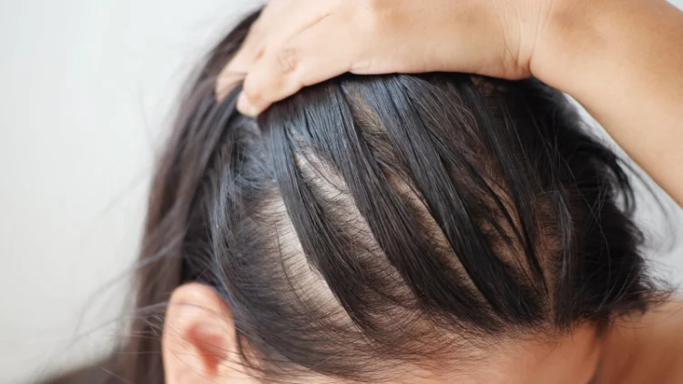 Reclaiming Your Crown: A Comprehensive Guide to Female Hair Loss Treatment